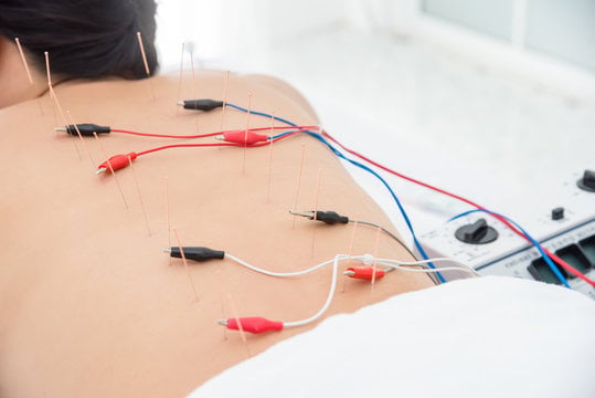 Electro-Acupuncture