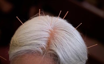 Scalp acupuncture treatment