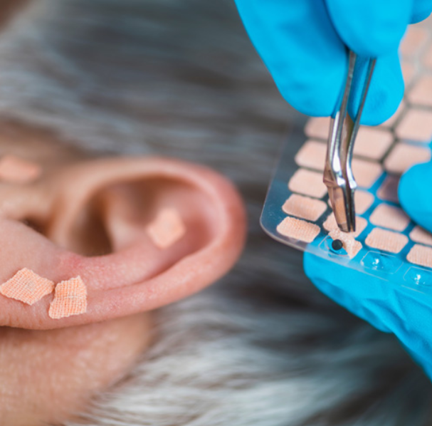 The Healing Power in Your Ears: Why I Love Using Ear Acupuncture in My Practice